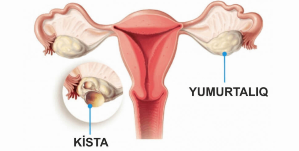 Yumurtaligin kistasi